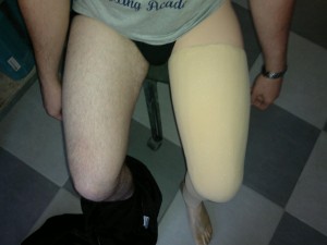 Pacjent z protezą nogi